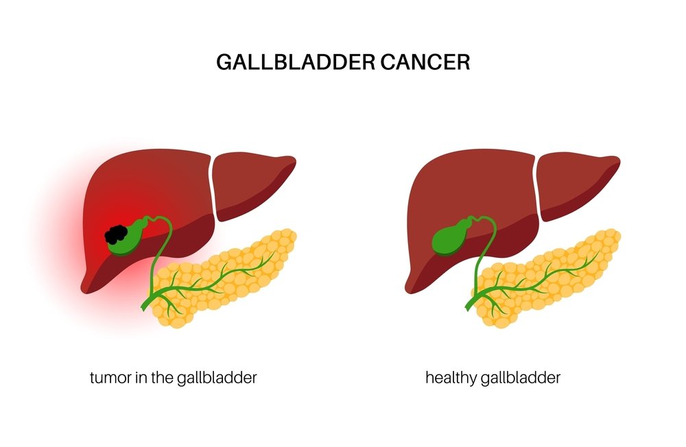 Gallbladder,Cancer,Concept.,Inflammation,In,The,Digestive,System,And,Abdomen