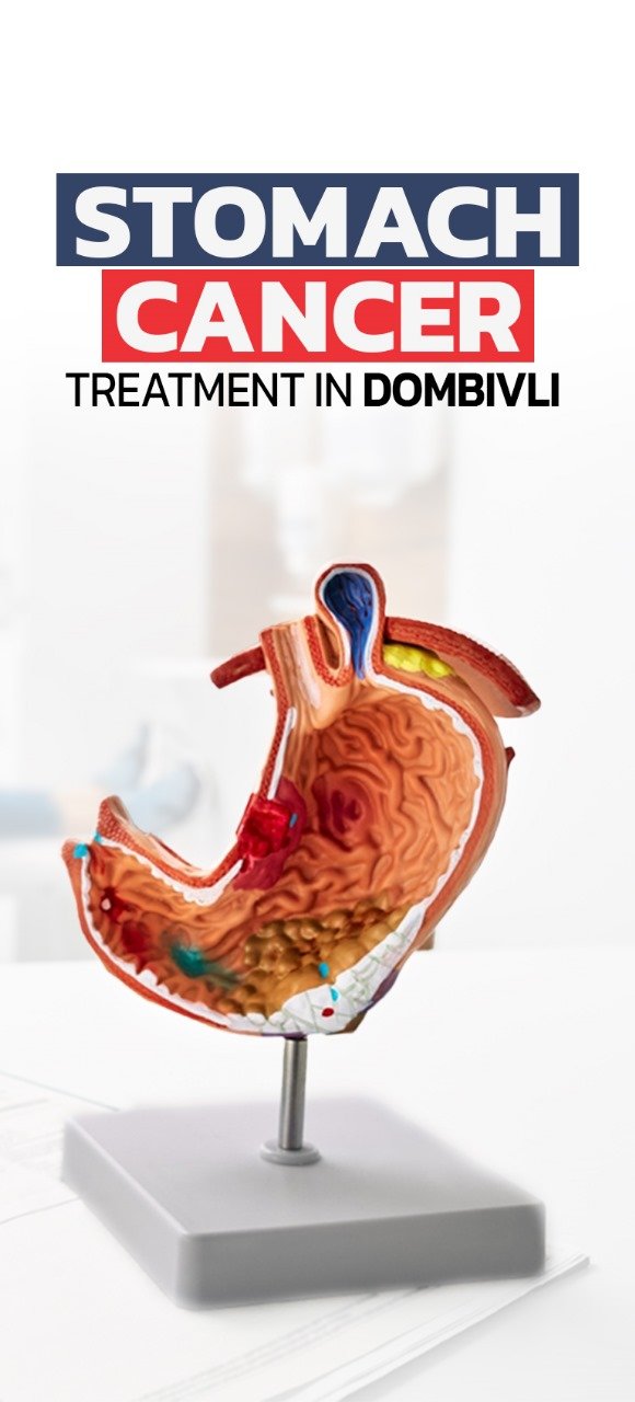 Stomach Cancer Treatment Dombivli