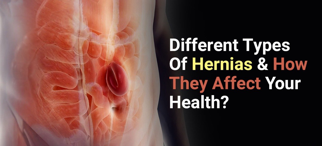 Hernias And How They Affect