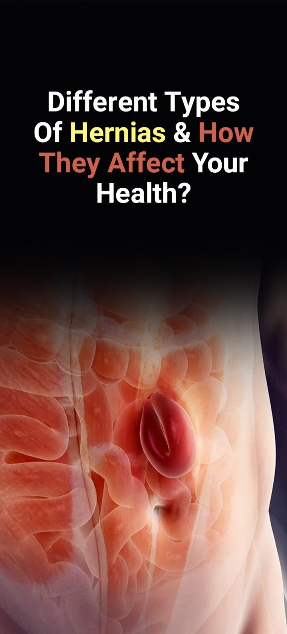 Hernias And How They Affect Your Health