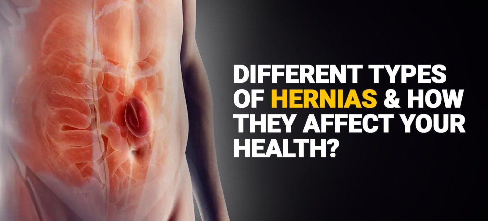 Different Types Of Hernias And How They Affect Your Health?