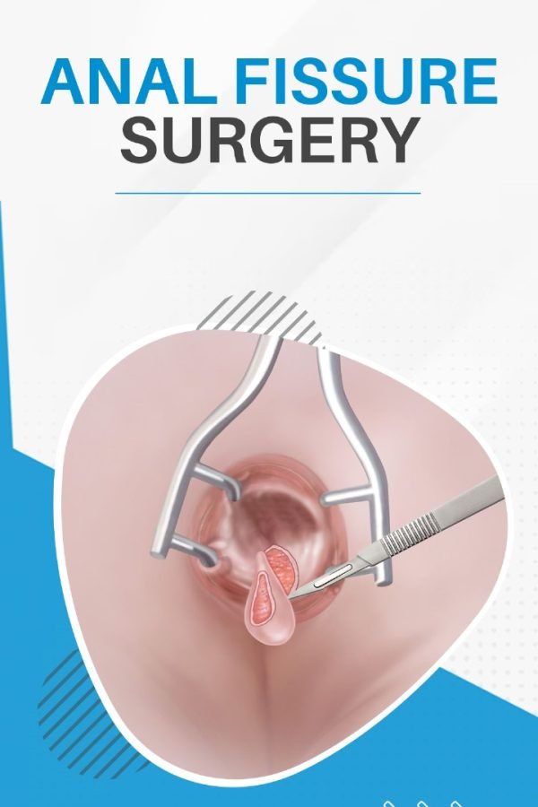 Anal Fissure Surgery