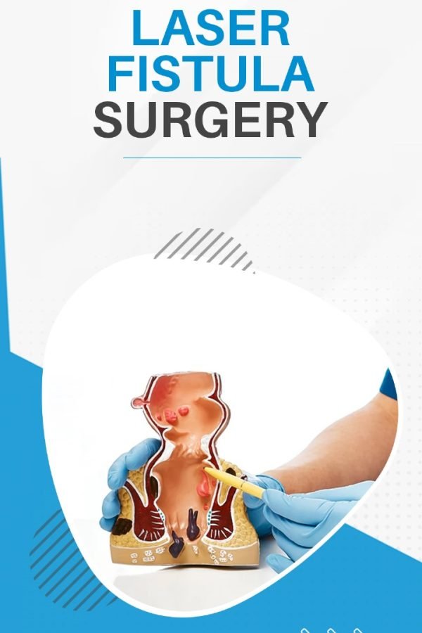 laser-fistula-surgery