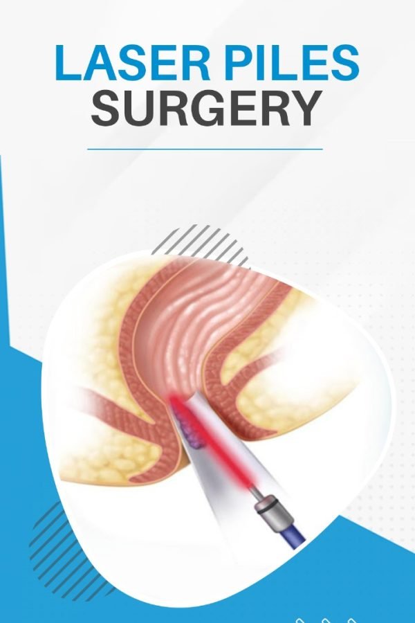 laser-piles-surgery